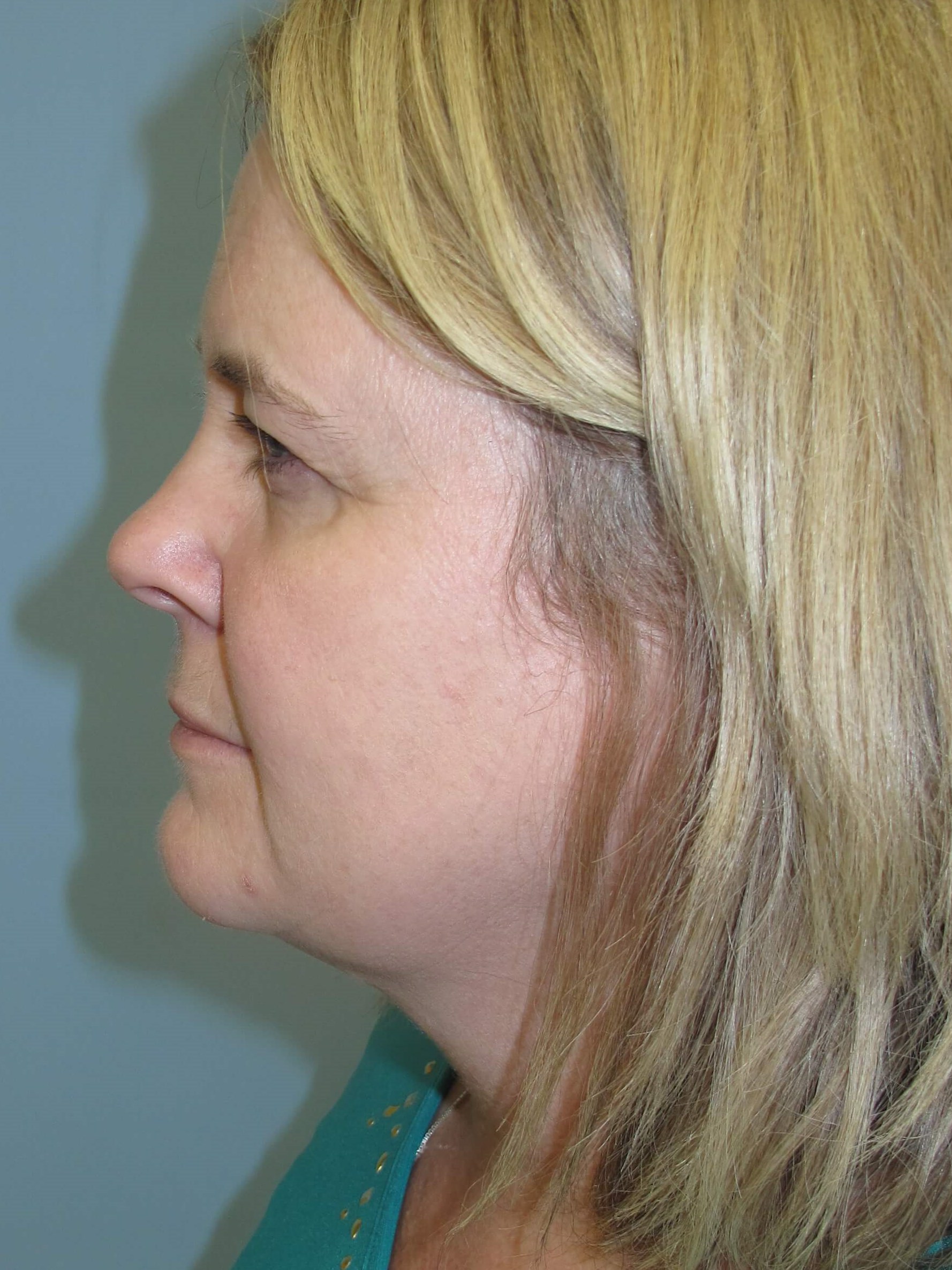 Upper eyelid blepharoplasty Before