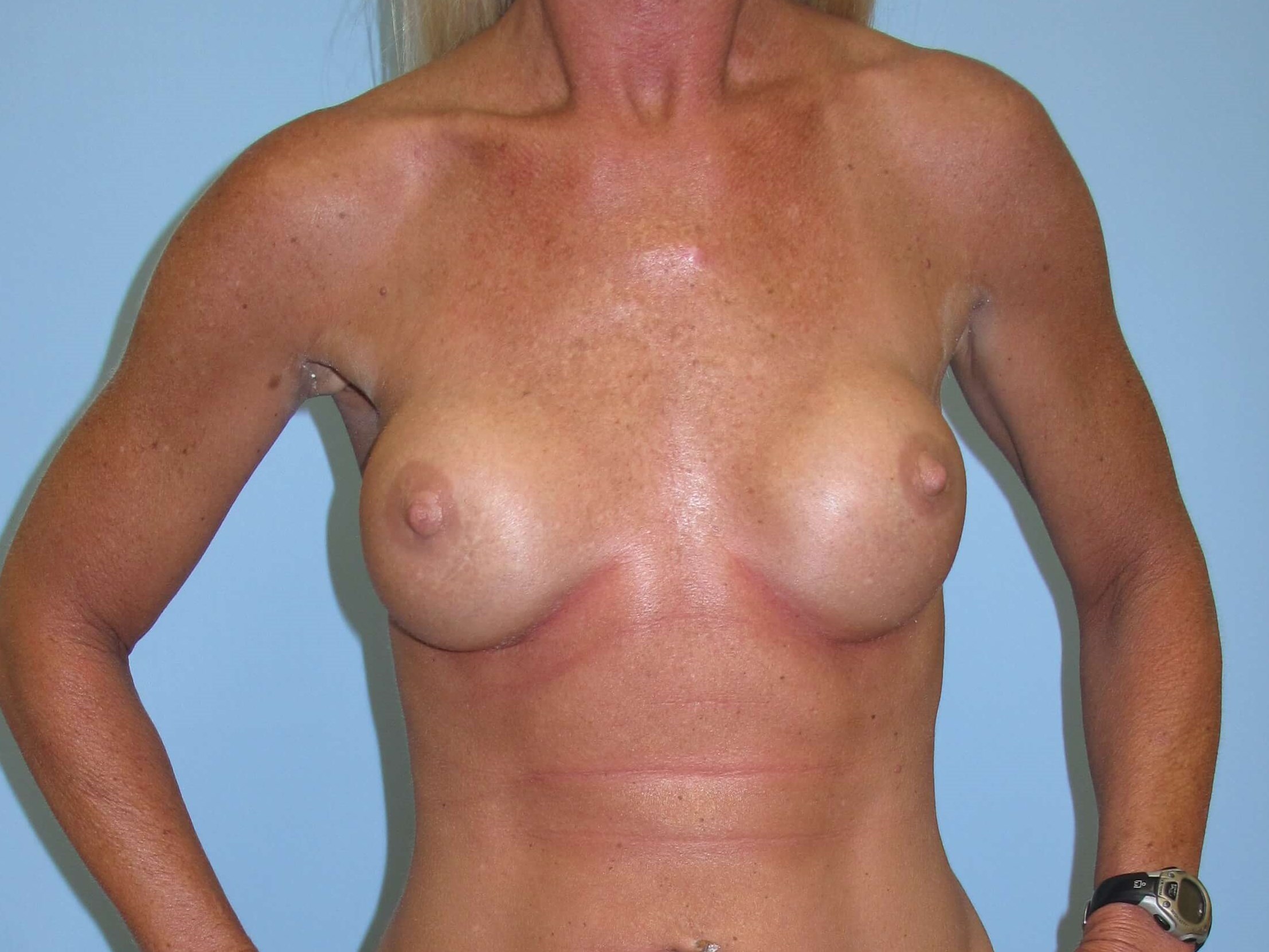 Breast Reconstruction Before