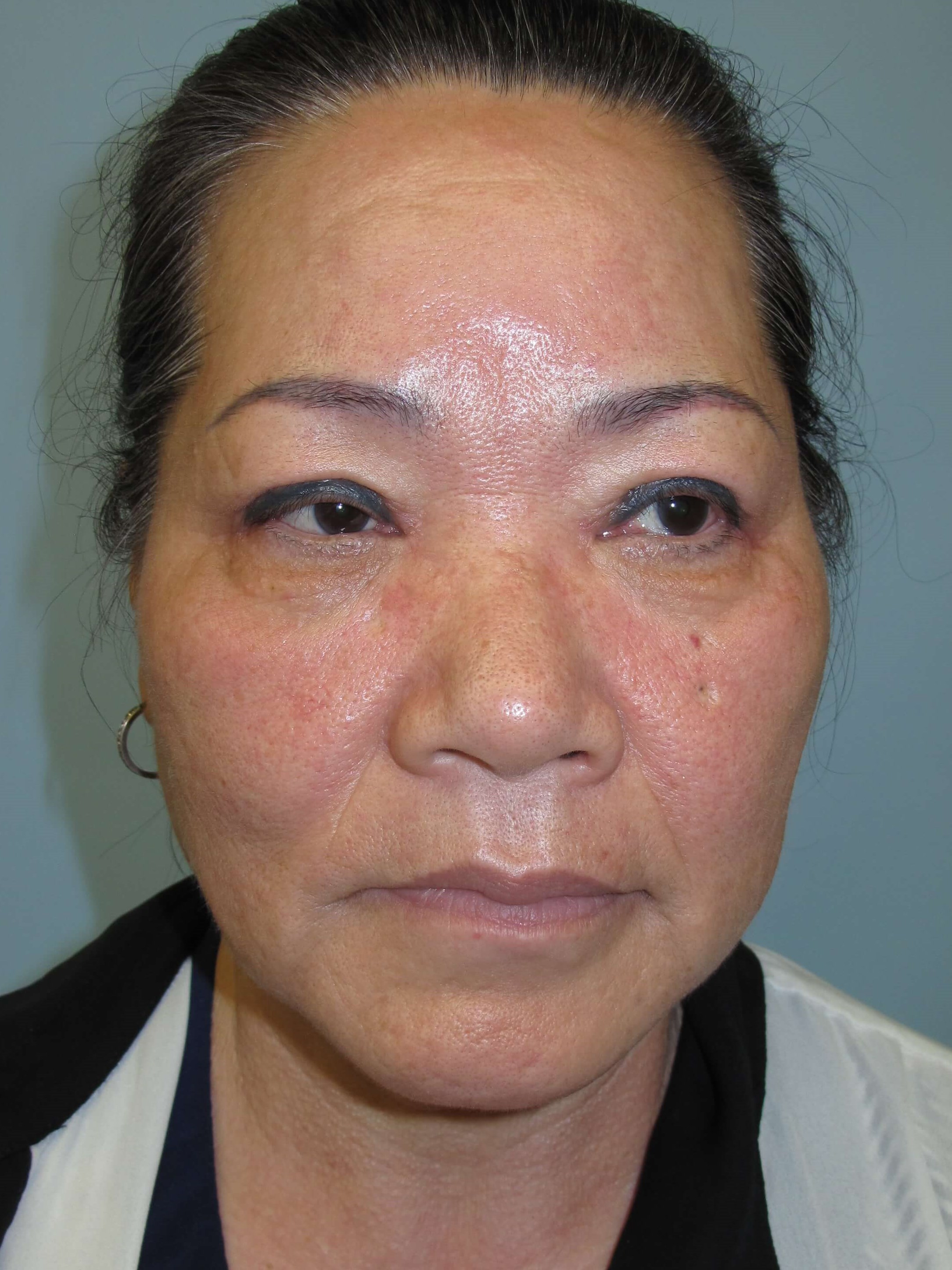 East Asian blepharoplasty After