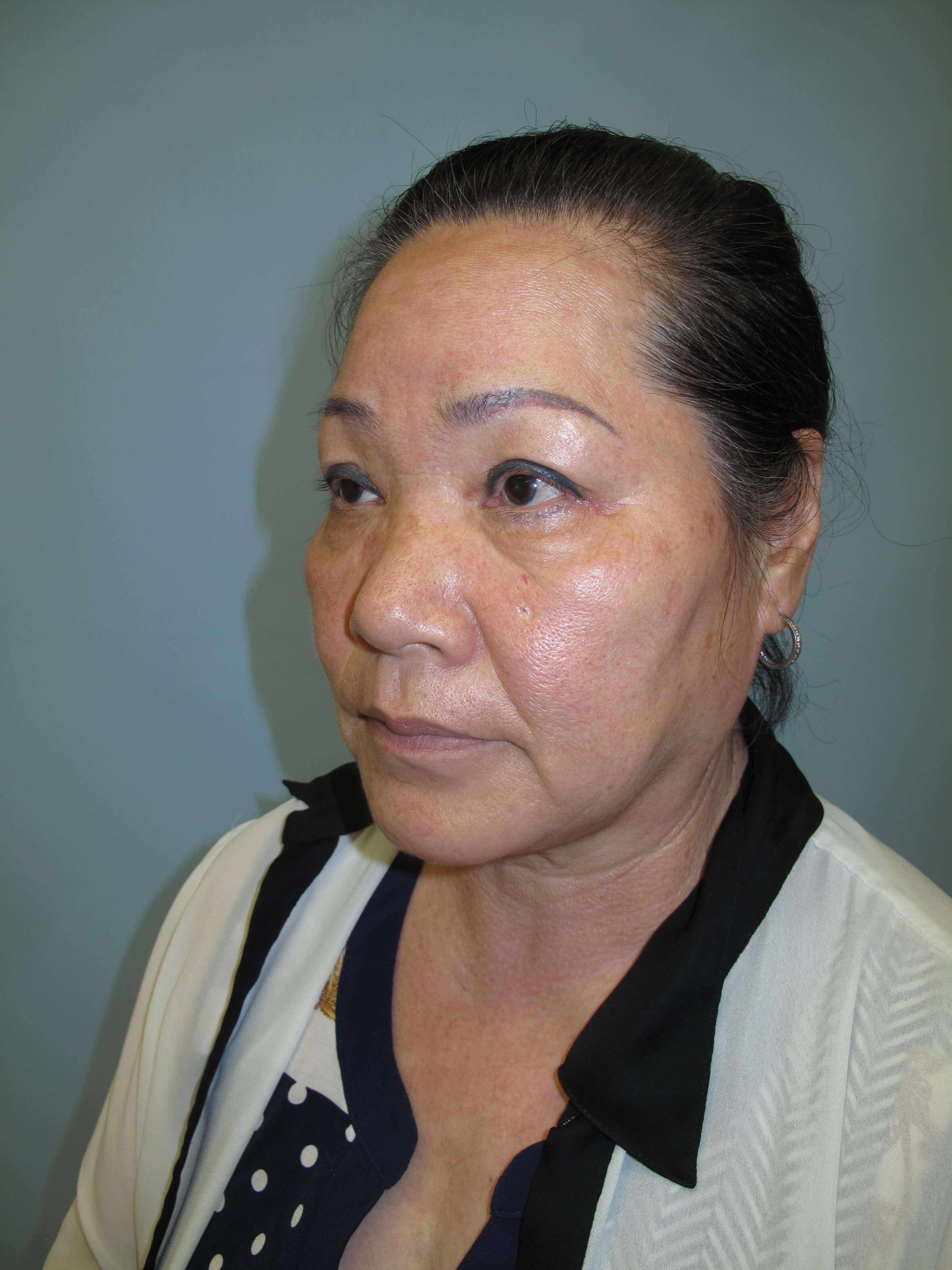 East Asian blepharoplasty After