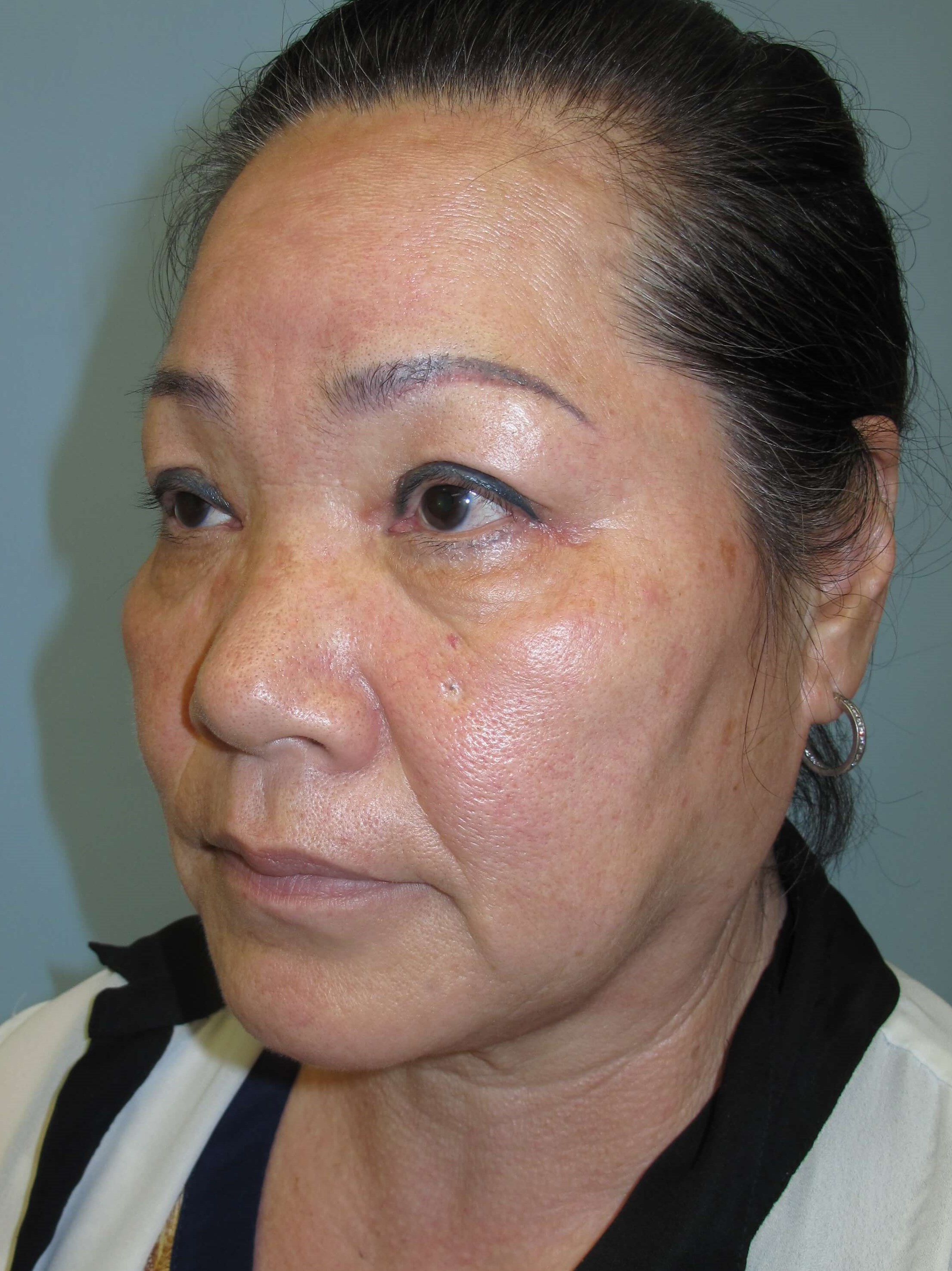 East Asian blepharoplasty After