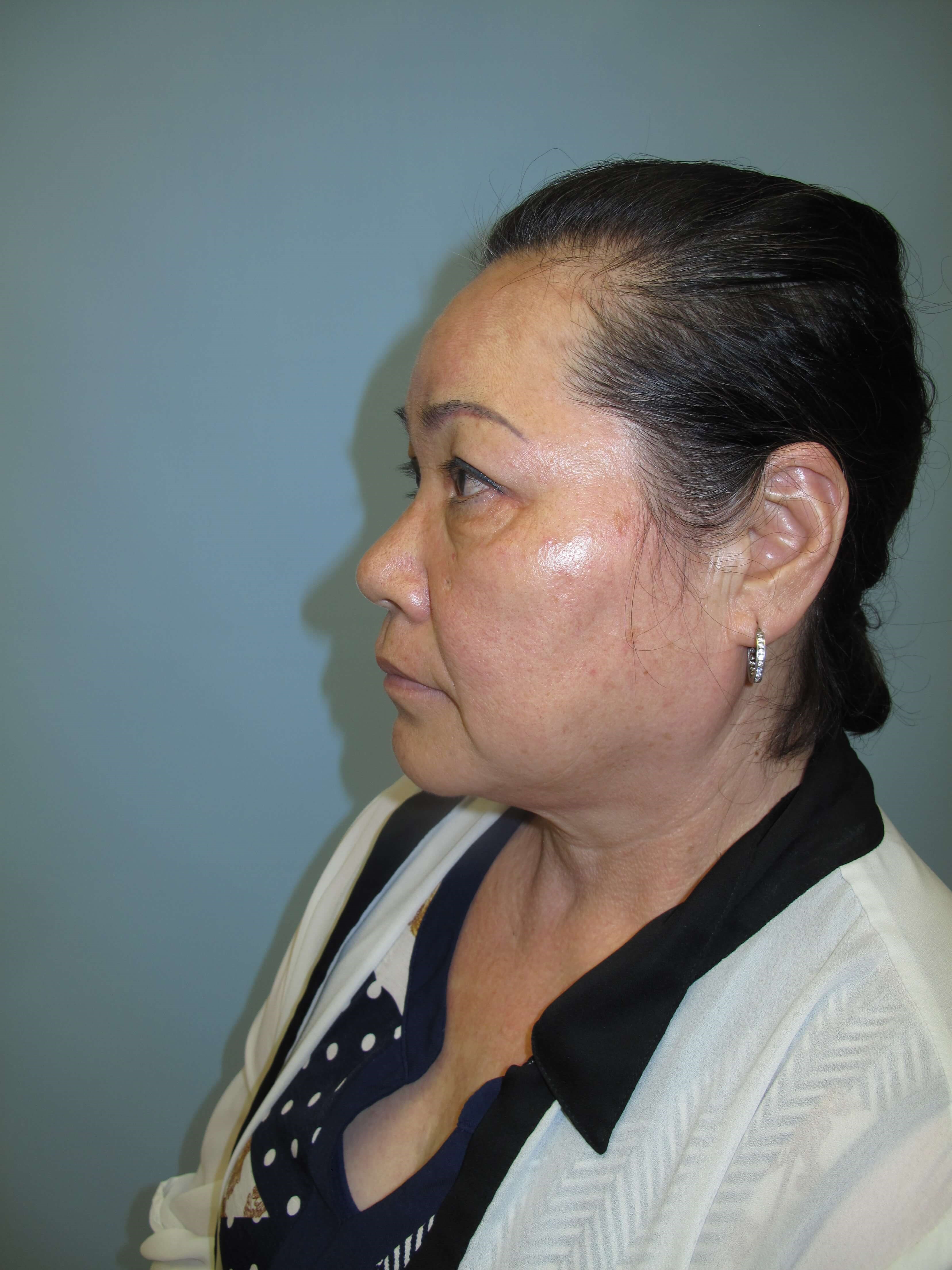 East Asian blepharoplasty After
