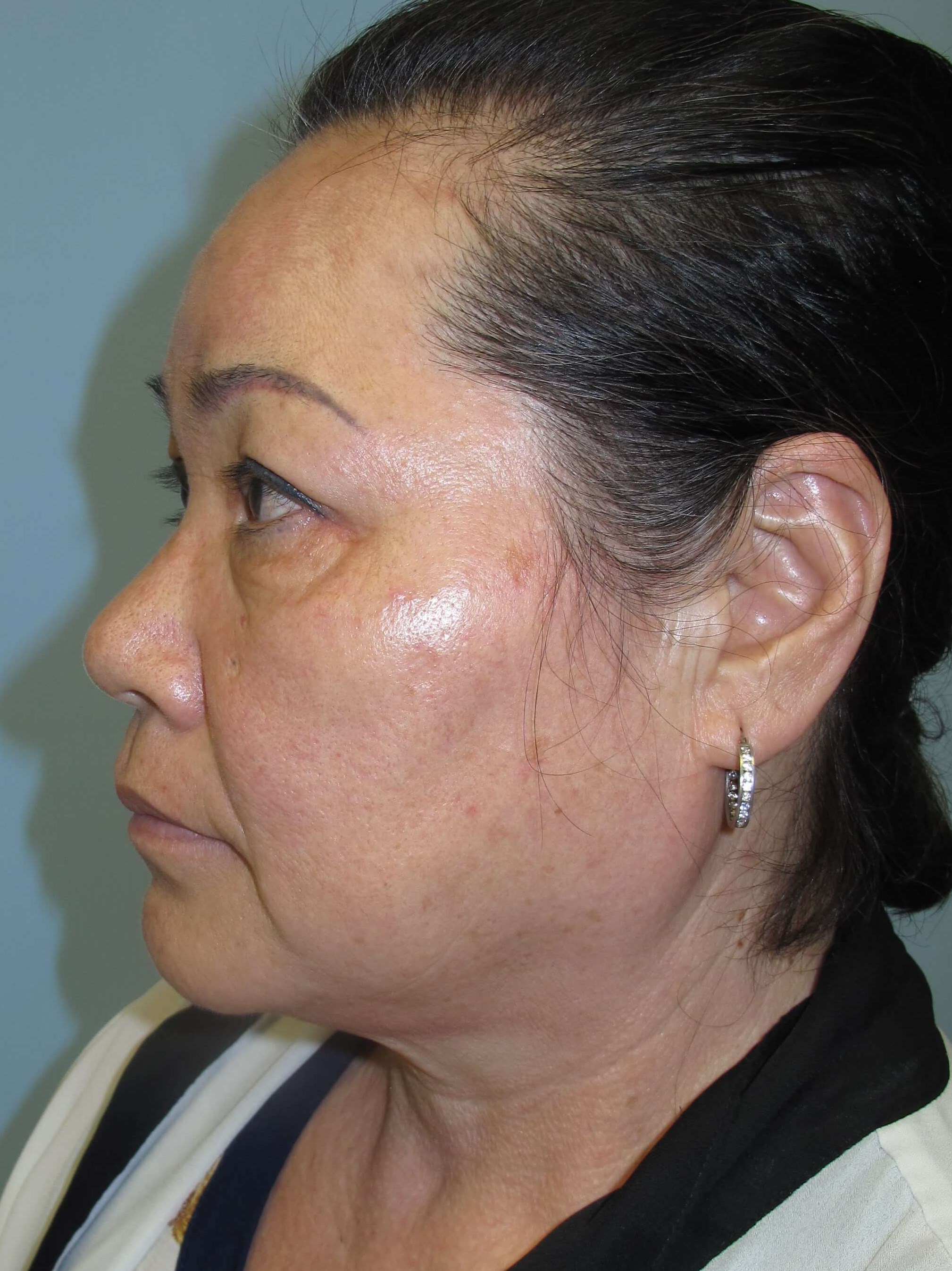 East Asian blepharoplasty After