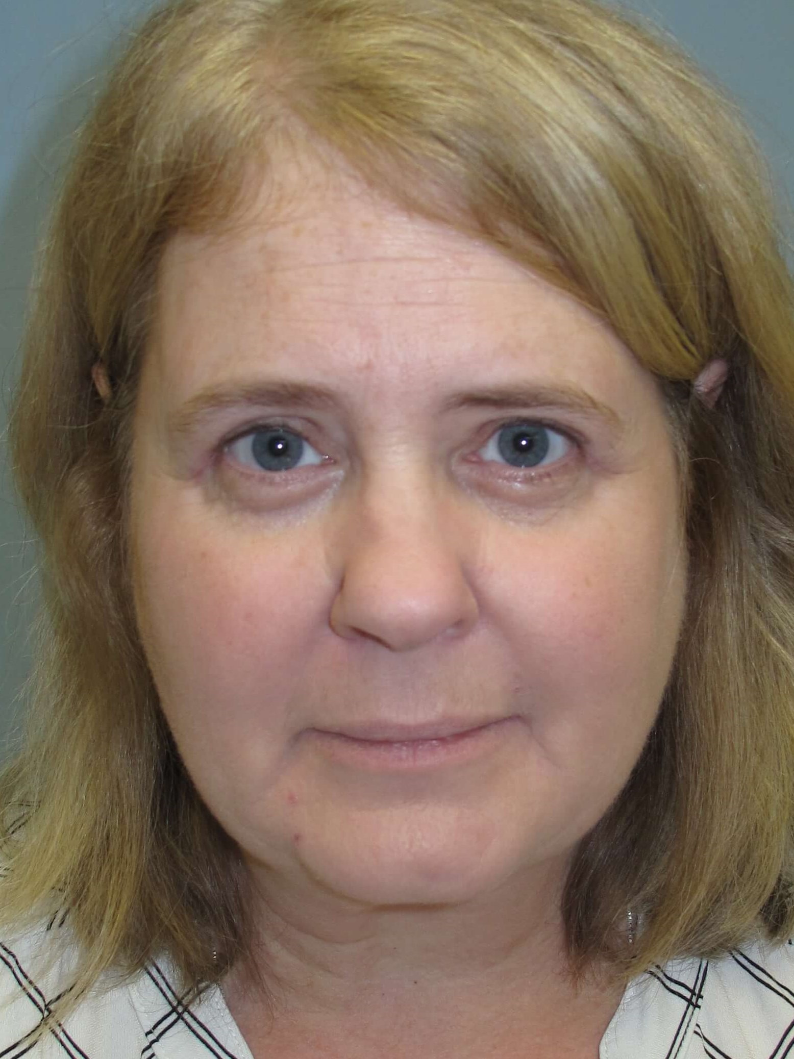 Upper eyelid blepharoplasty After