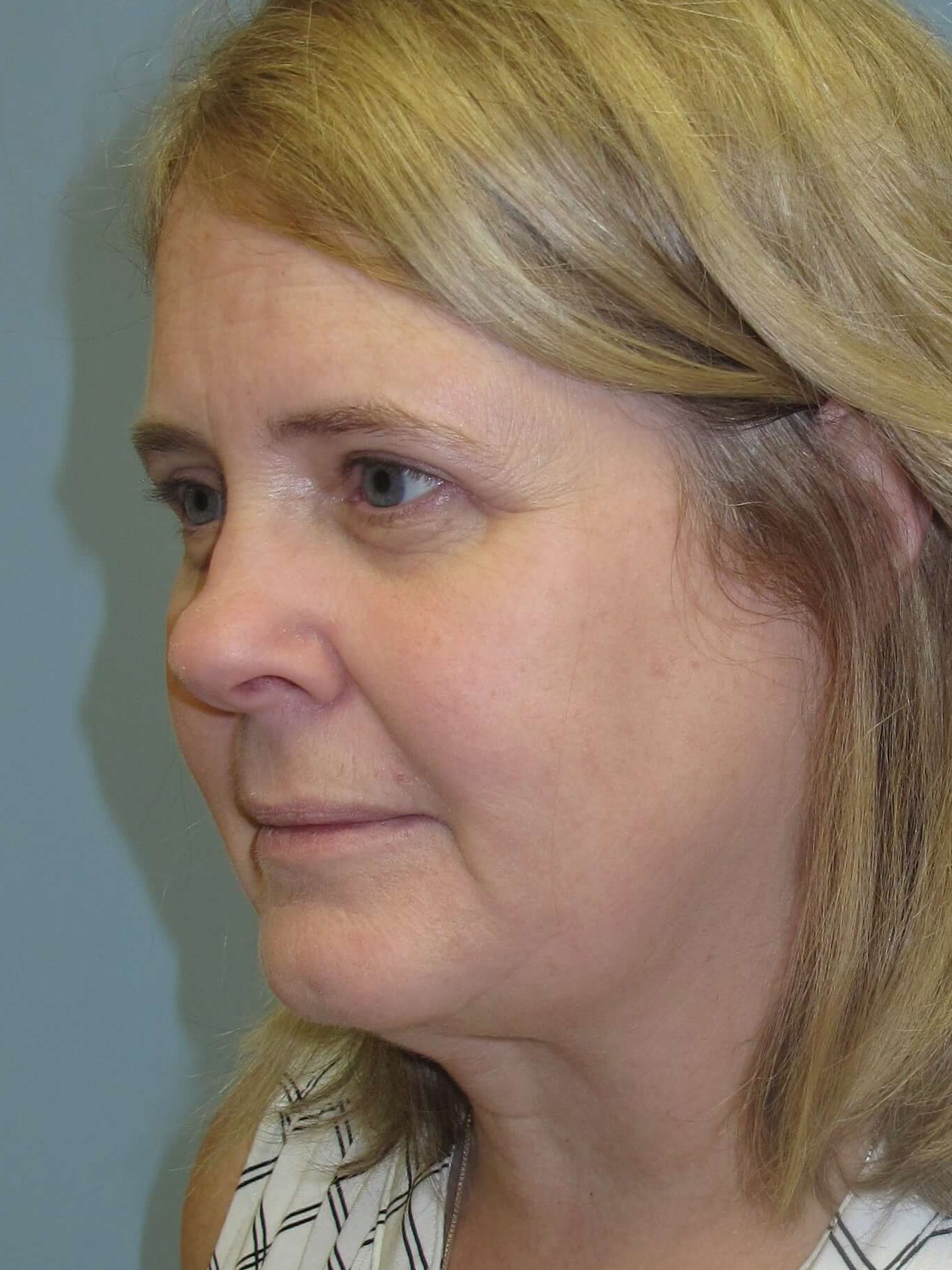Upper eyelid blepharoplasty After