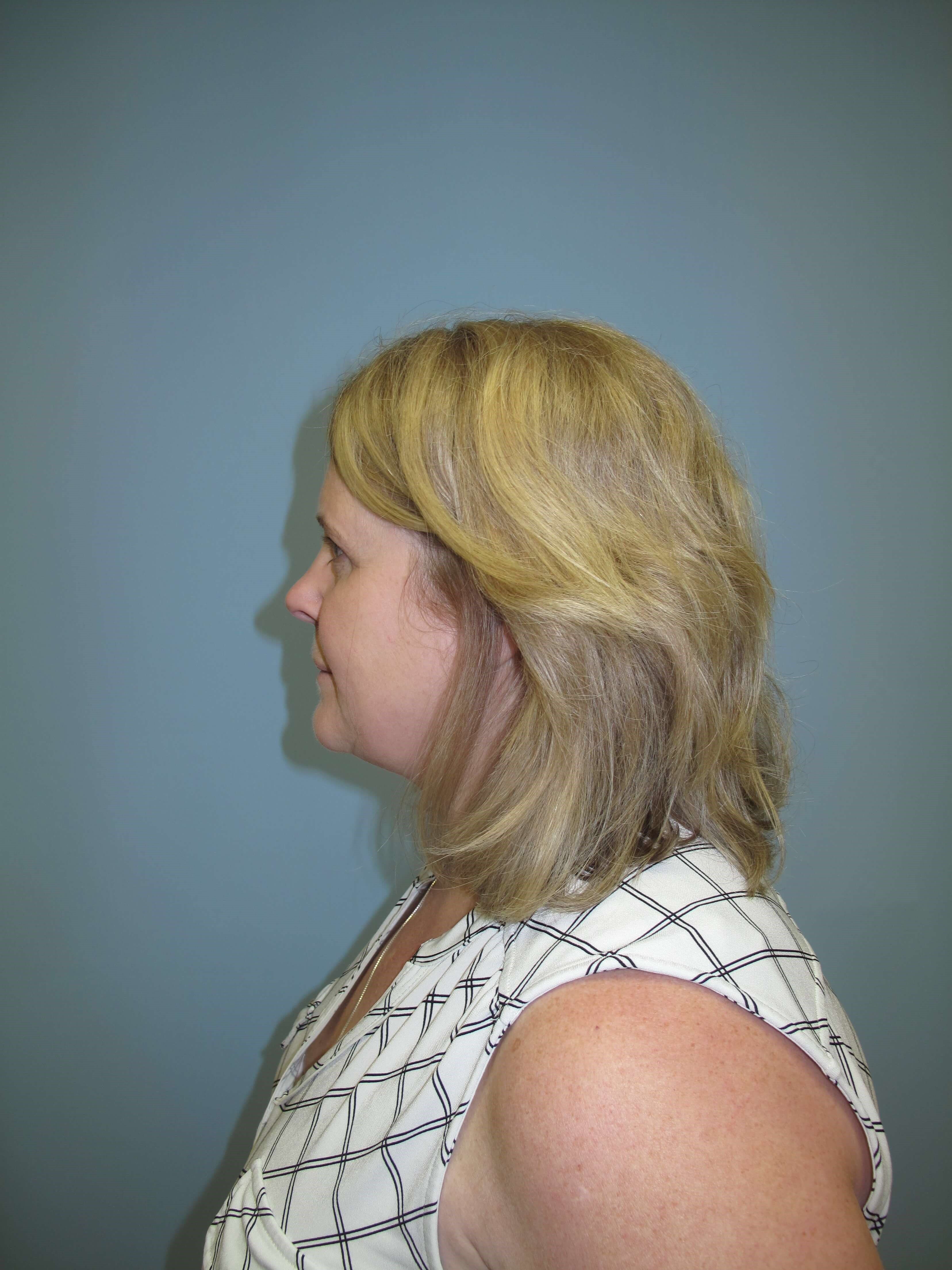 Upper eyelid blepharoplasty After