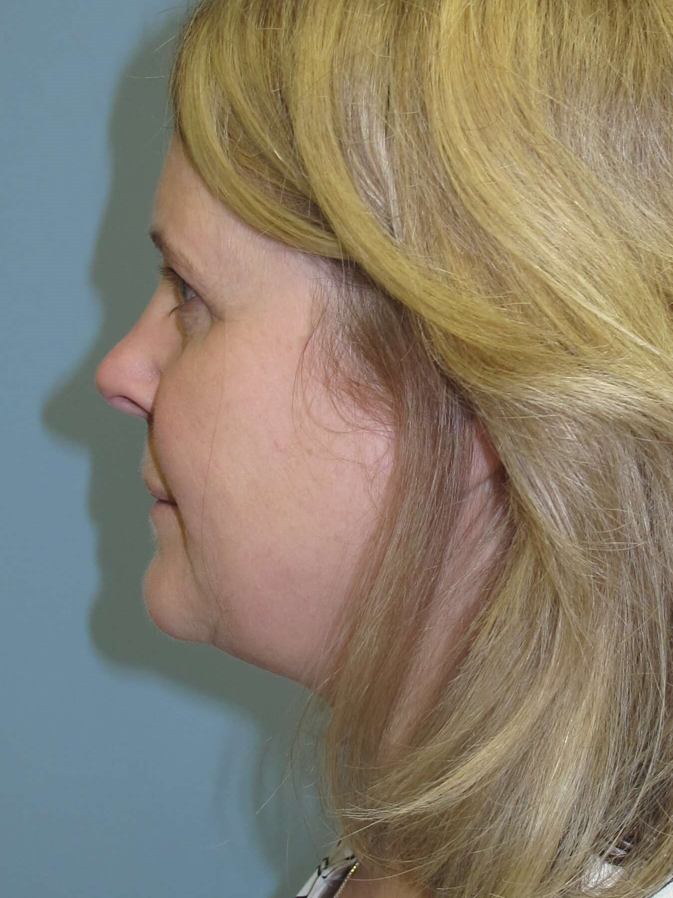 Upper eyelid blepharoplasty After