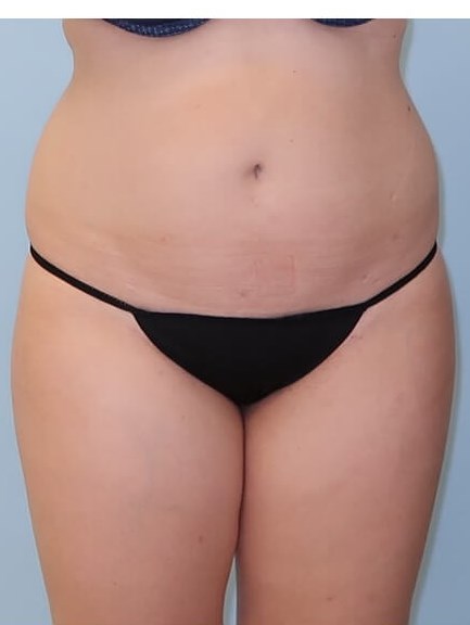 UltraShape Power/VelaShape III After