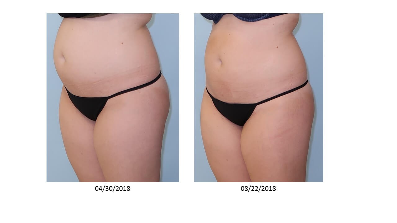UltraShape Power/VelaShape III Before
