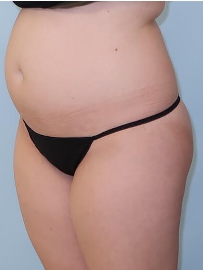 UltraShape Power/VelaShape III Before