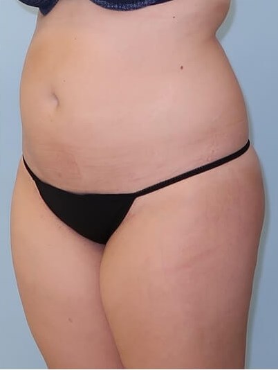 UltraShape Power/VelaShape III After