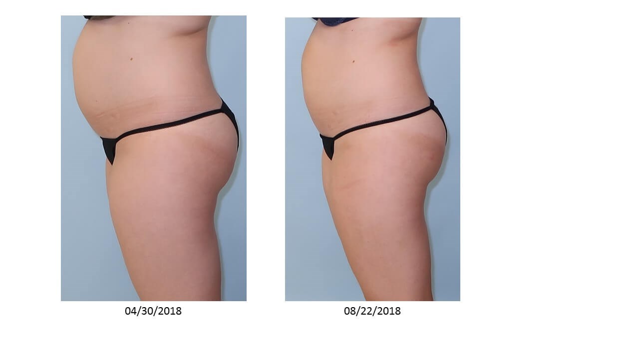 UltraShape Power/VelaShape III Before
