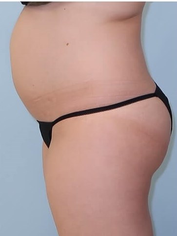 UltraShape Power/VelaShape III Before