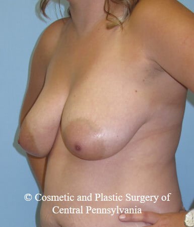 Breast Reconstruction Before