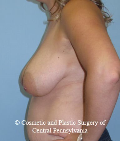 Breast Reconstruction Before