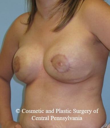 Breast Reconstruction After