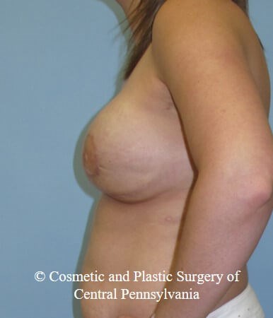 Breast Reconstruction After