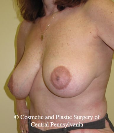 Breast Reconstruction Before