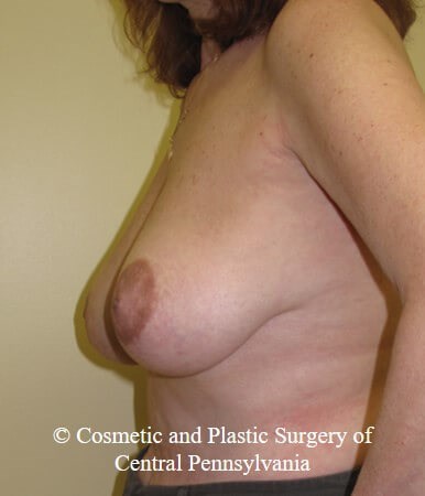 Breast Reconstruction Before