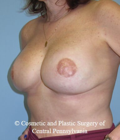 Breast Reconstruction After