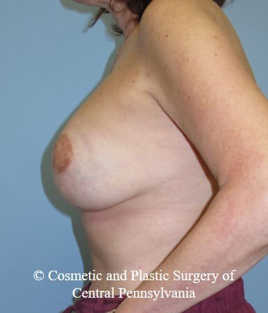 Breast Reconstruction After