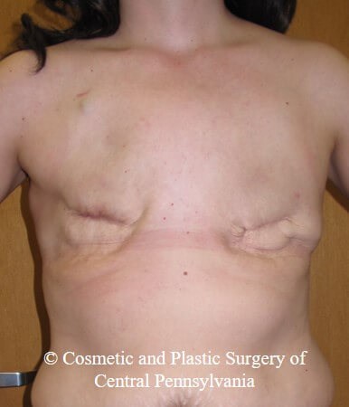 Breast Reconstruction Before