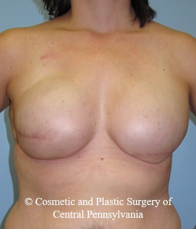Breast Reconstruction After