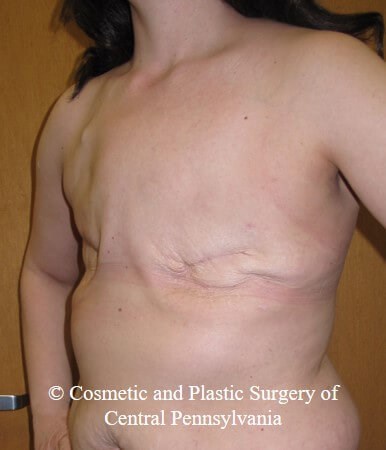 Breast Reconstruction Before