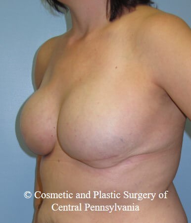 Breast Reconstruction After