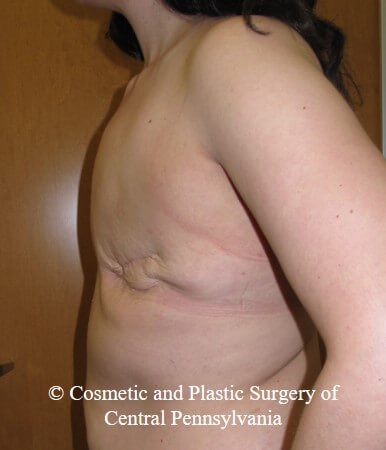Breast Reconstruction Before