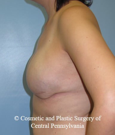 Breast Reconstruction After