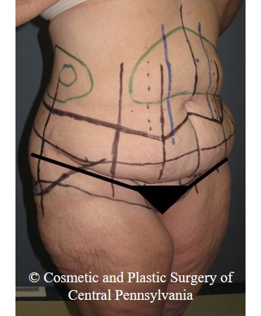 Circumferential Body Lift Before