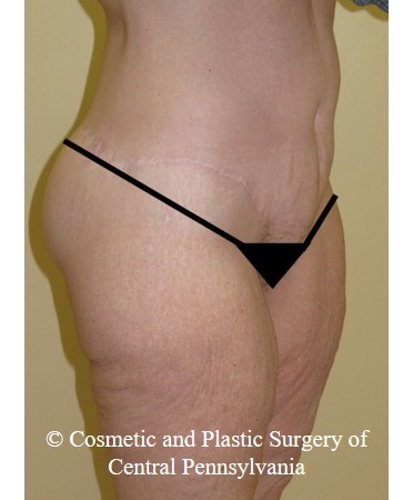Circumferential Body Lift After