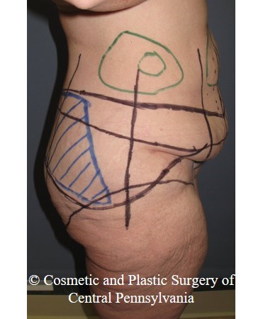 Circumferential Body Lift Before