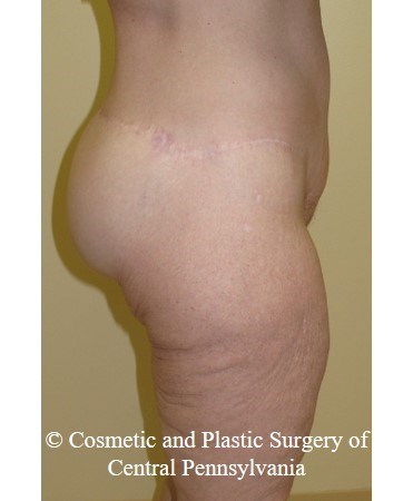 Circumferential Body Lift After