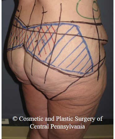 Circumferential Body Lift Before