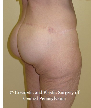 Circumferential Body Lift After