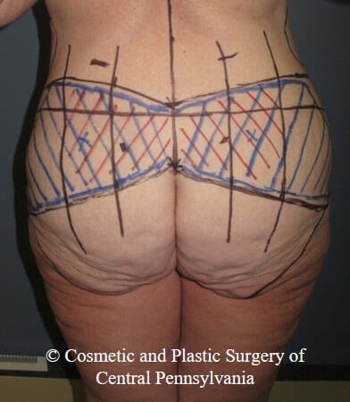Circumferential Body Lift Before