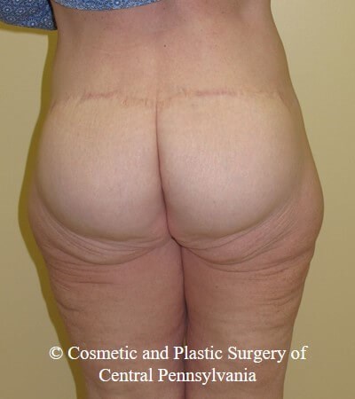 Circumferential Body Lift After