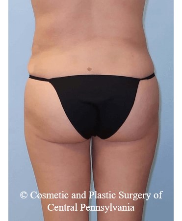 Brazilian Butt Lift After