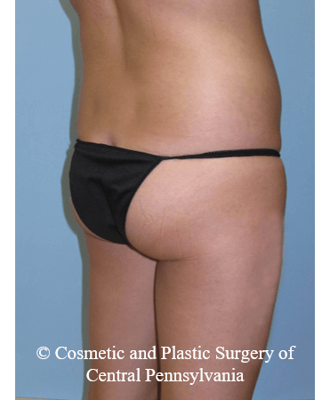 Brazilian Butt Lift Before