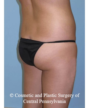 Brazilian Butt Lift Before