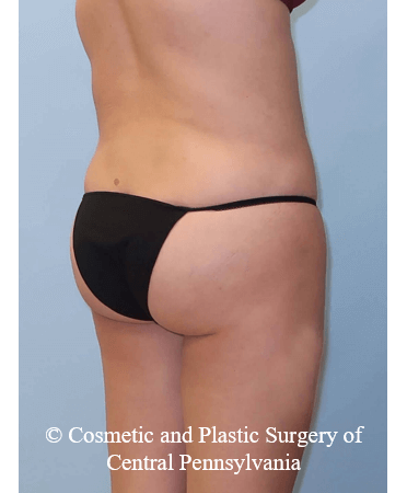 Brazilian Butt Lift After