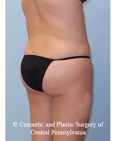 Brazilian Butt Lift After