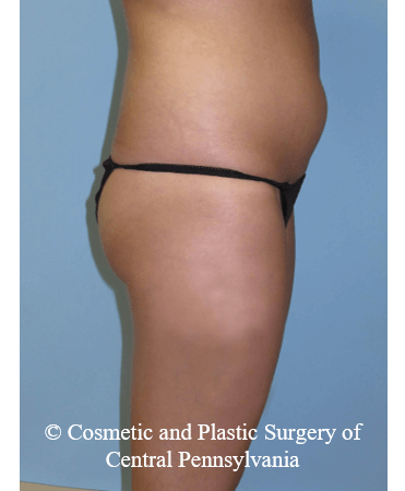 Brazilian Butt Lift Before