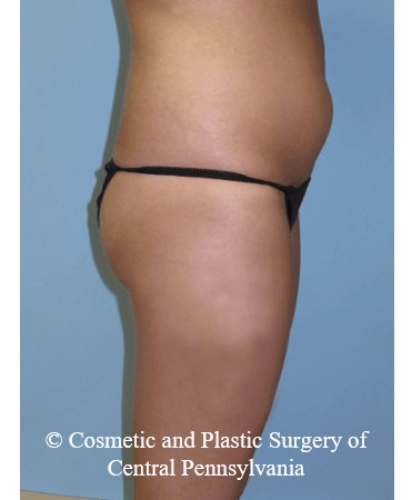 Brazilian Butt Lift Before