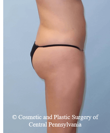 Brazilian Butt Lift After