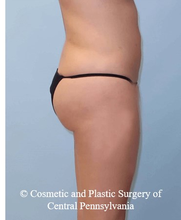 Brazilian Butt Lift After