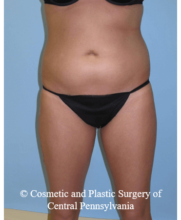 Brazilian Butt Lift ( BBL ) Before