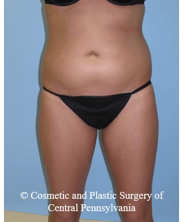 Brazilian Butt Lift ( BBL ) Before